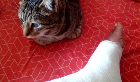 Achilles tendon tear